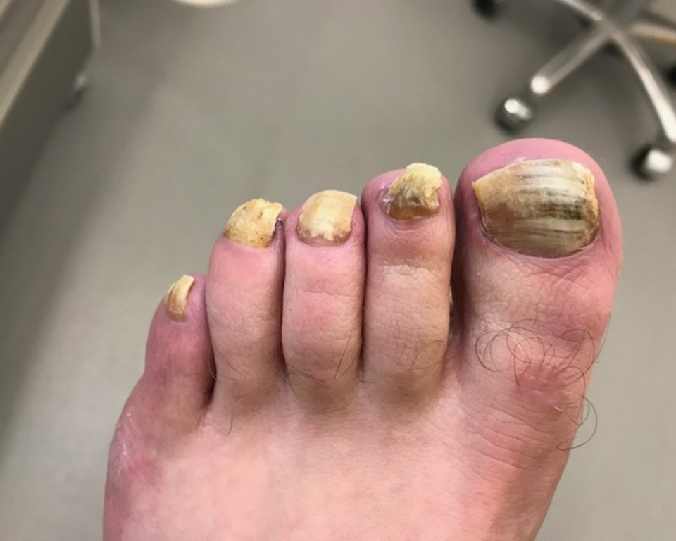 Fungal Nail Infection
