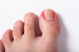 Do I have an Ingrown Toenail?