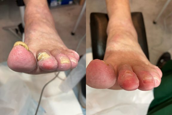 Toe tip view fungal nails