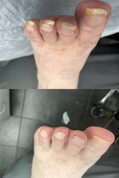 Painful nails Painful nails