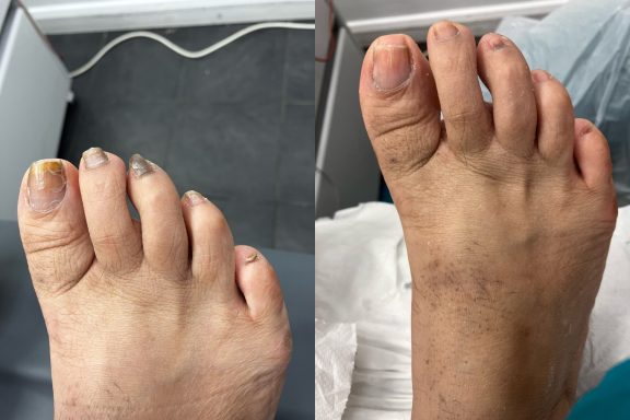 Fungal nails