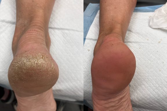 Dry cracked heels Dry cracked heels