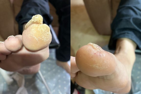 Thick callus build up Thick callus build up