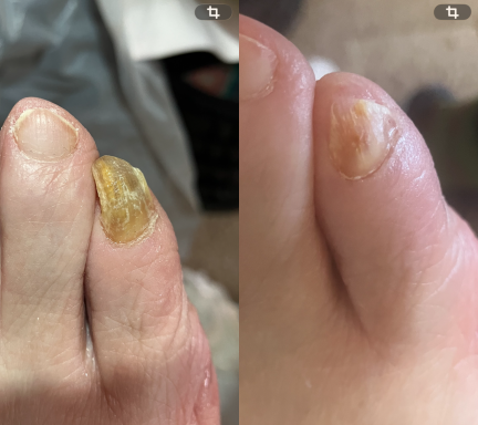 Fungal nail reduction Fungal nail restoration