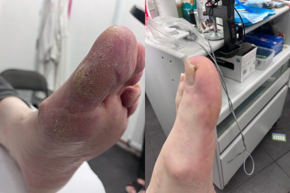 Crusty callus gone!! Crusty callus gone!!
