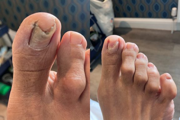 Fungal nail removal Fungal nail removal
