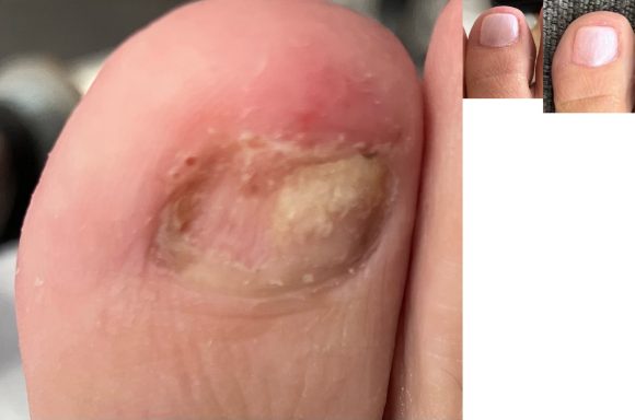 Fungal Toenail reconstruction Fungal toenail reconstruction