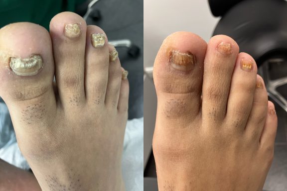 Fungal nail restoration