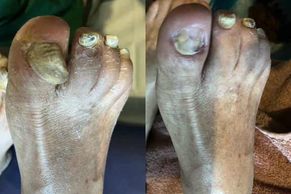 Fungal nail Fungal nail