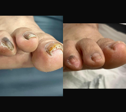 20 years fungal nail after one treatment Fungal nail