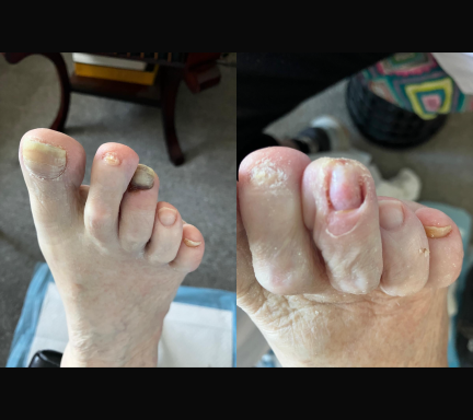 Full nail removal Detached nail