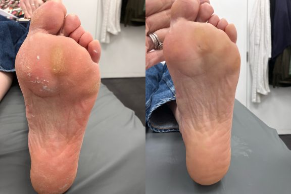 Close-up of a human foot sole showing texture and skin details.