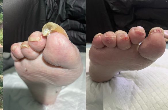 Overgrown curly toenails Overgrown curly toenails