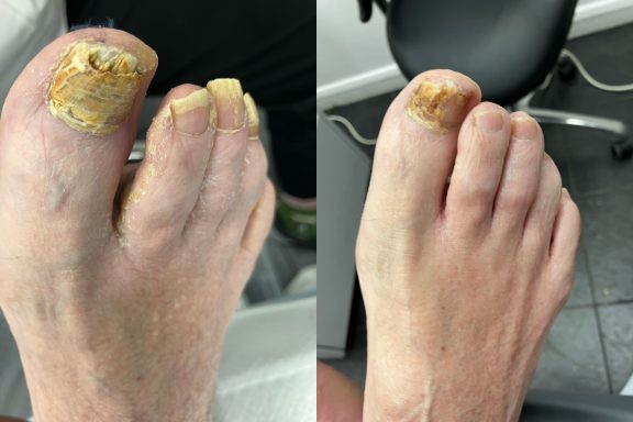 Fungal nail Fungal nail