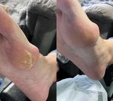 Callus Removal