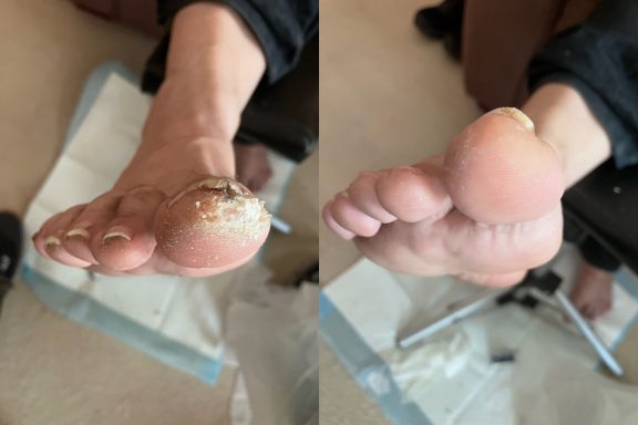 Apex callus removal Apex callus removal