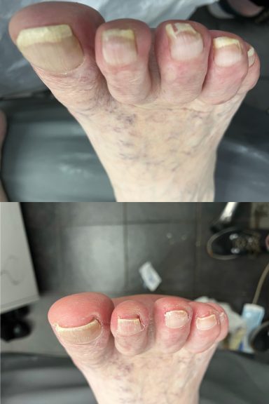 Painful nails Painful nails