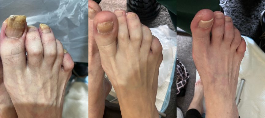 Fungal nail transformation 12 week transformation