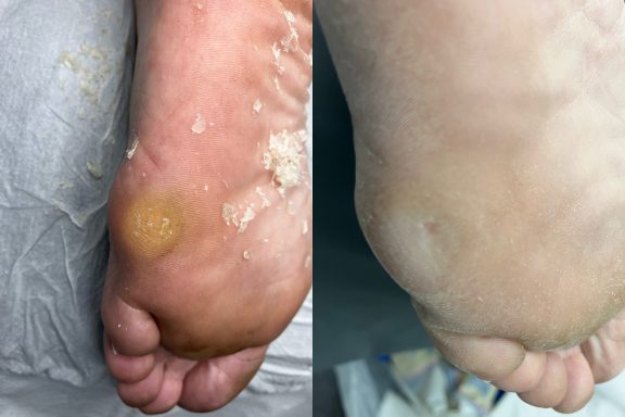 Deep callus removal Deep callus removal