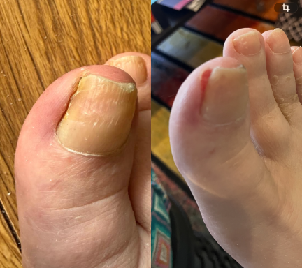 Ingrown Toe Nail Ingrown Toe Nail