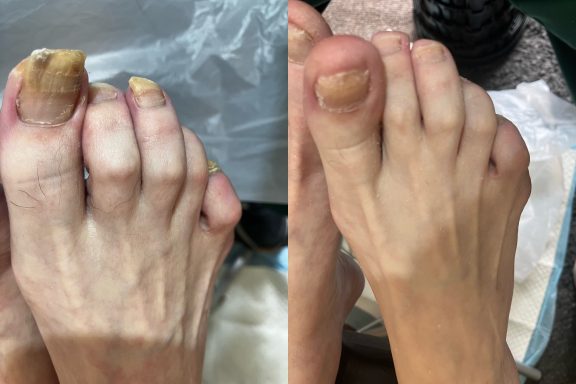 Fungal nail Fungal nail