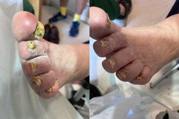 Fungal nail Fungal nail