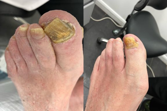 Fungal nail after one treatment Fungal nail