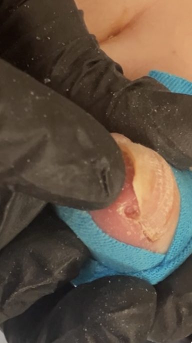Ingrown toenail removal Ingrown toenail removal