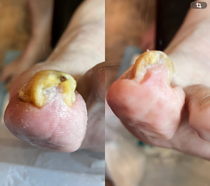 Thick fungal nail Thick Pincer nail