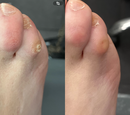 Side-by-side comparison of two toes showing skin conditions and differences in colour and texture.