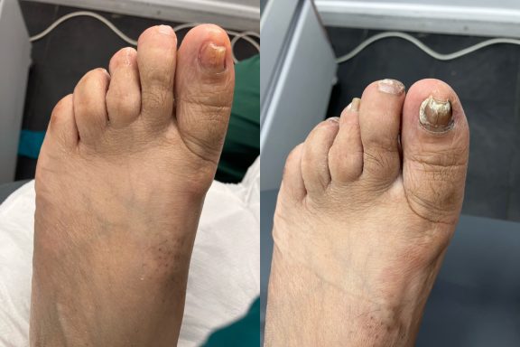 20 year fungal nail improvement