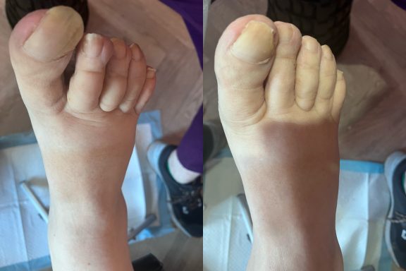 Severs cracked heals Severe cracked heals