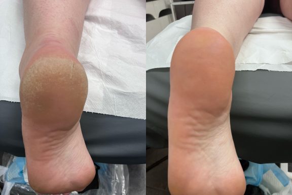 1cm callus removal from the heal Removal of 1cm thick heal callus