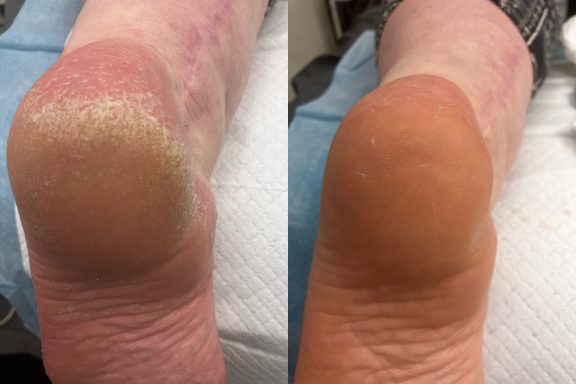 Dry painful heels Dry cracked heels