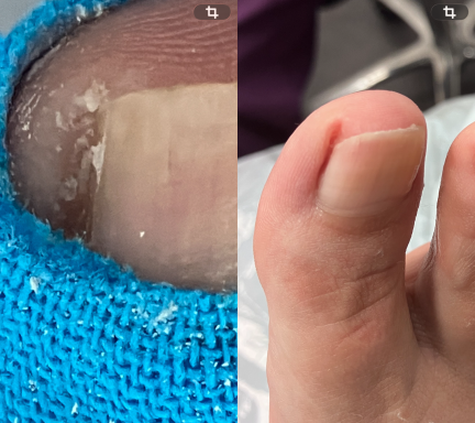 Ingrown toenail Ingrown toenail
