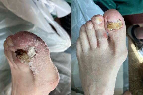 Fungal nail Fungal nail