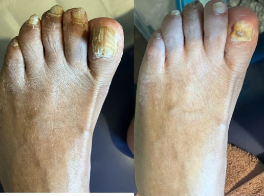 Fungal nail Fungal nail