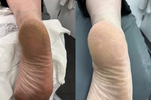 Dry cracked heels Dry cracked heels