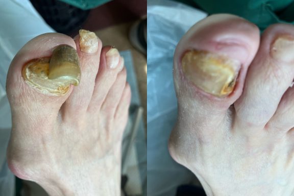 Fungal nail Sever fungal toenail after one visit