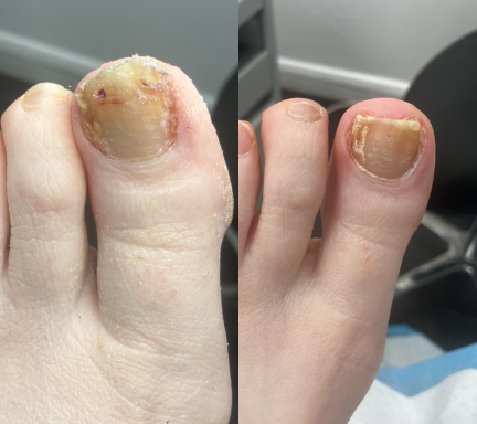 Fungal Nail Treatment Fungal Nail Treatment