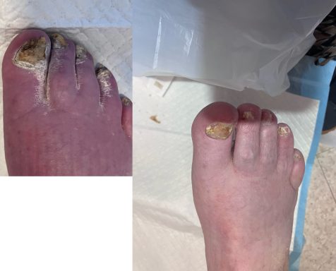 Fungal nail Fungal nail