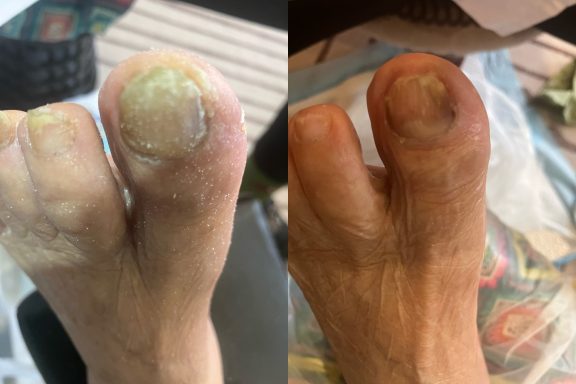 Fungal Nail Fungal Nail