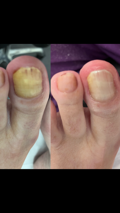 Fungal nail Fungal nail