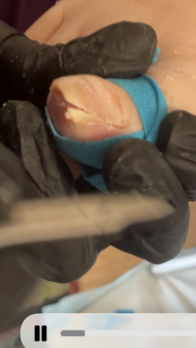 Ingrown toenail removal Ingrown toenail removal