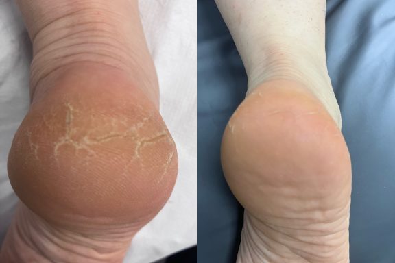 Severe cracked heals Severe cracked heals