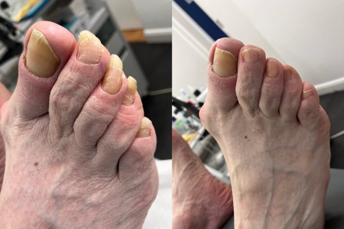 General toe tip General toenail trim