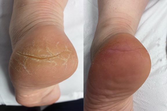Severe cracked heals Severe cracked heals