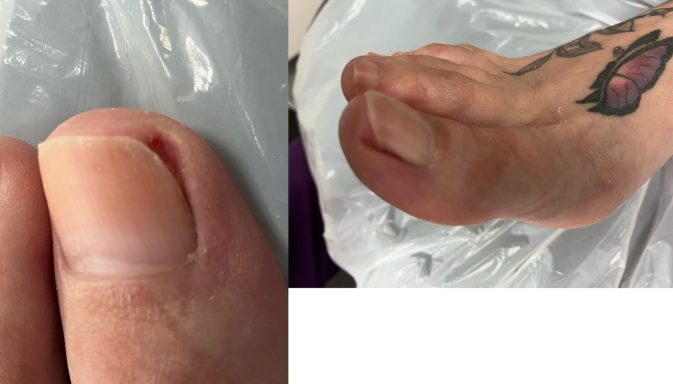 Ingrown toenail Ingrown toenail